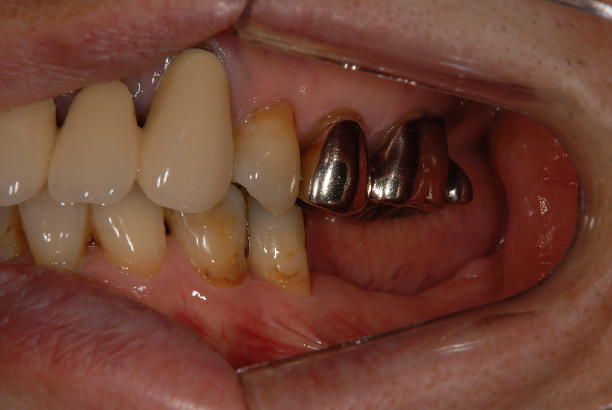 奥歯 2 入れ歯 本 部分 下顎の奥歯が2本欠損